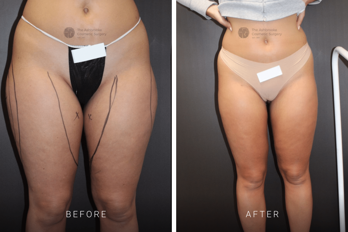 Abdomen Liposuction - Australia Cosmetic Clinics