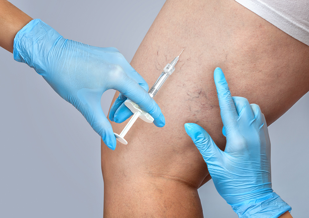 varicose vein injections