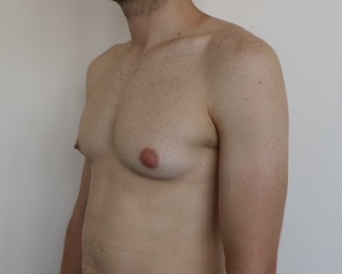 gynecomastia