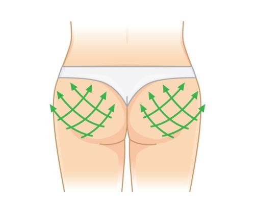 minimally invasive butt lift